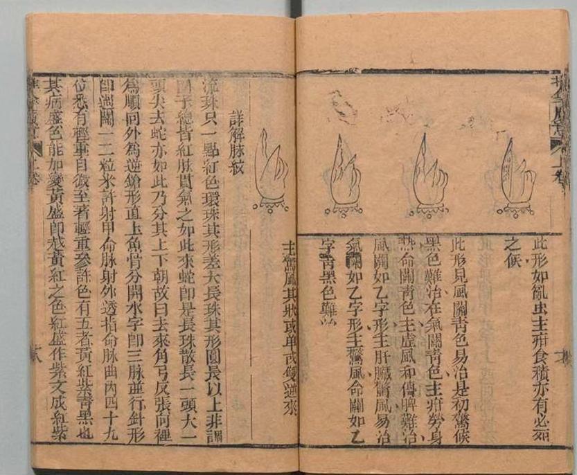 中医古籍 道光本《小儿推拿广意》(图5)