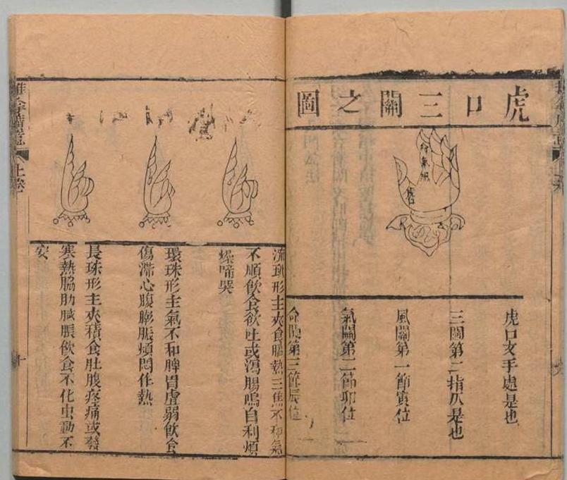 中医古籍 道光本《小儿推拿广意》(图6)